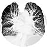 misdiagnosis of pulmonary embolism