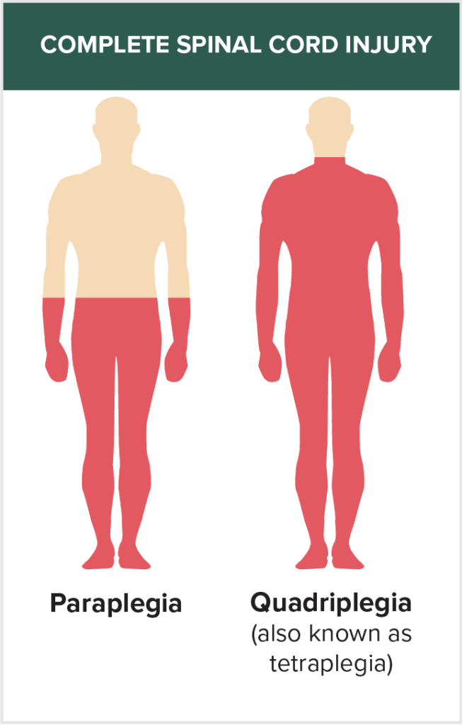 complete spinal cord injury