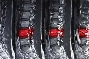 Spinal cord injury